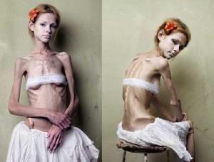 anorexia2